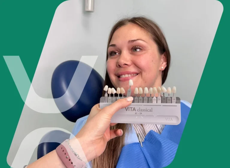 Faccette dentali Faccette dentali